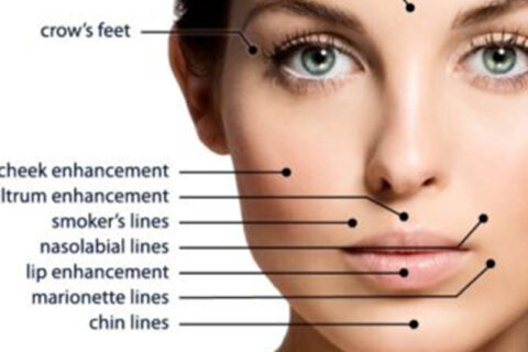 dermal fillers treatment points on a women's face