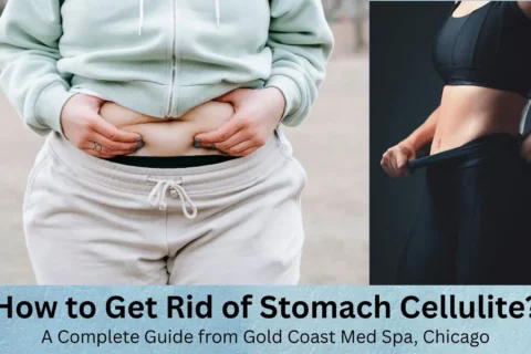 How to Get Rid of Stomach Cellulite? A Complete Guide from Gold Coast Med Spa, Chicago