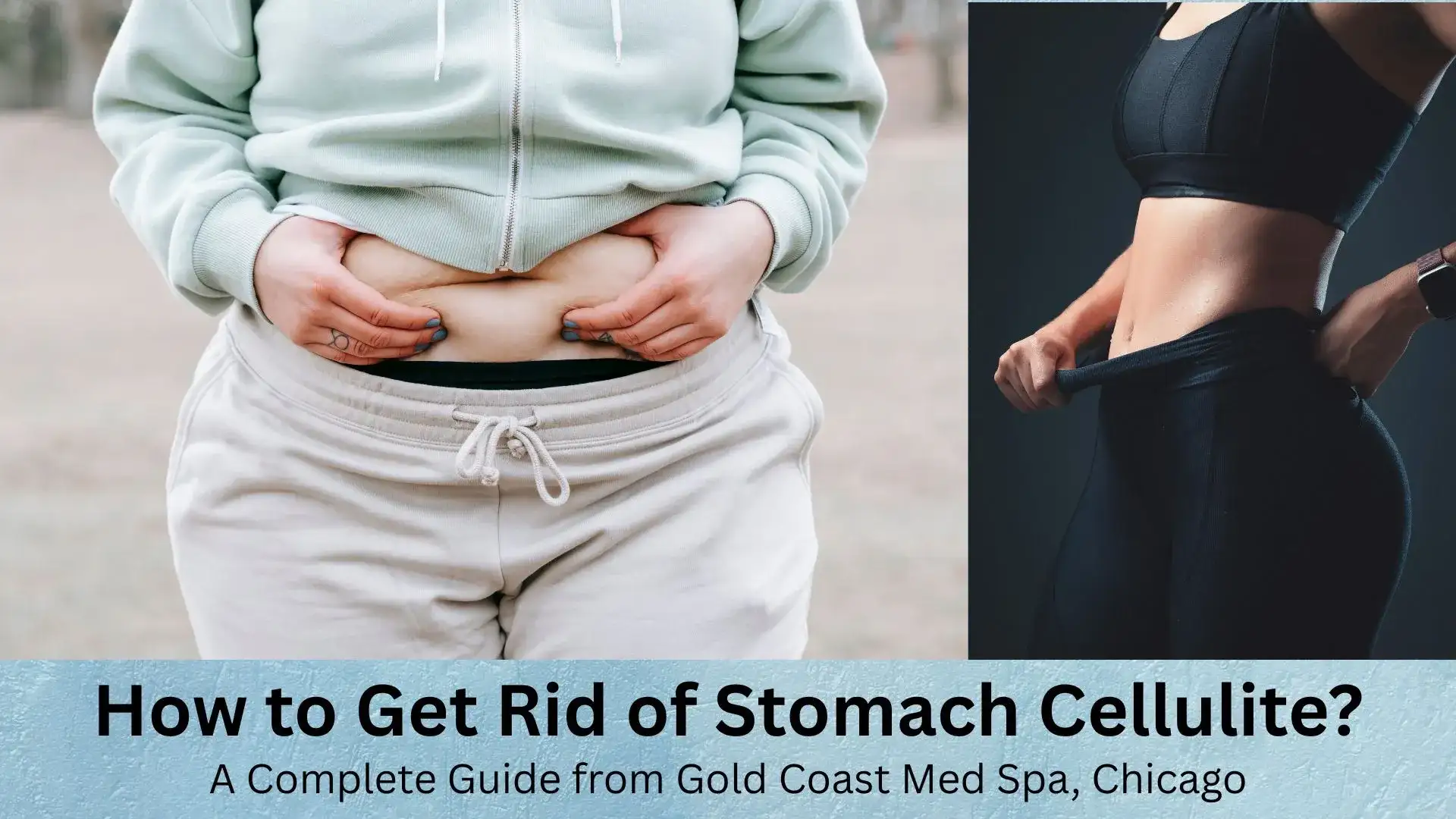 How to Get Rid of Stomach Cellulite? A Complete Guide from Gold Coast Med Spa, Chicago