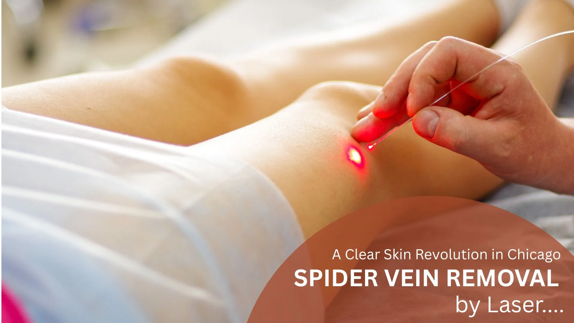 Spider Vein Removal by Laser
