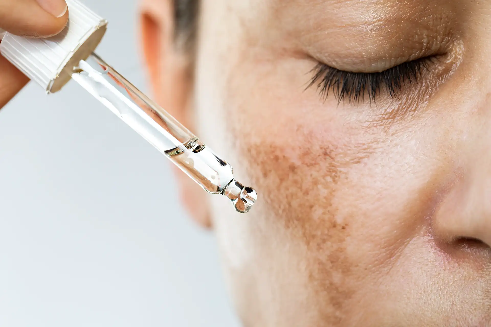 Why Chicago Residents Love Chemical Peels