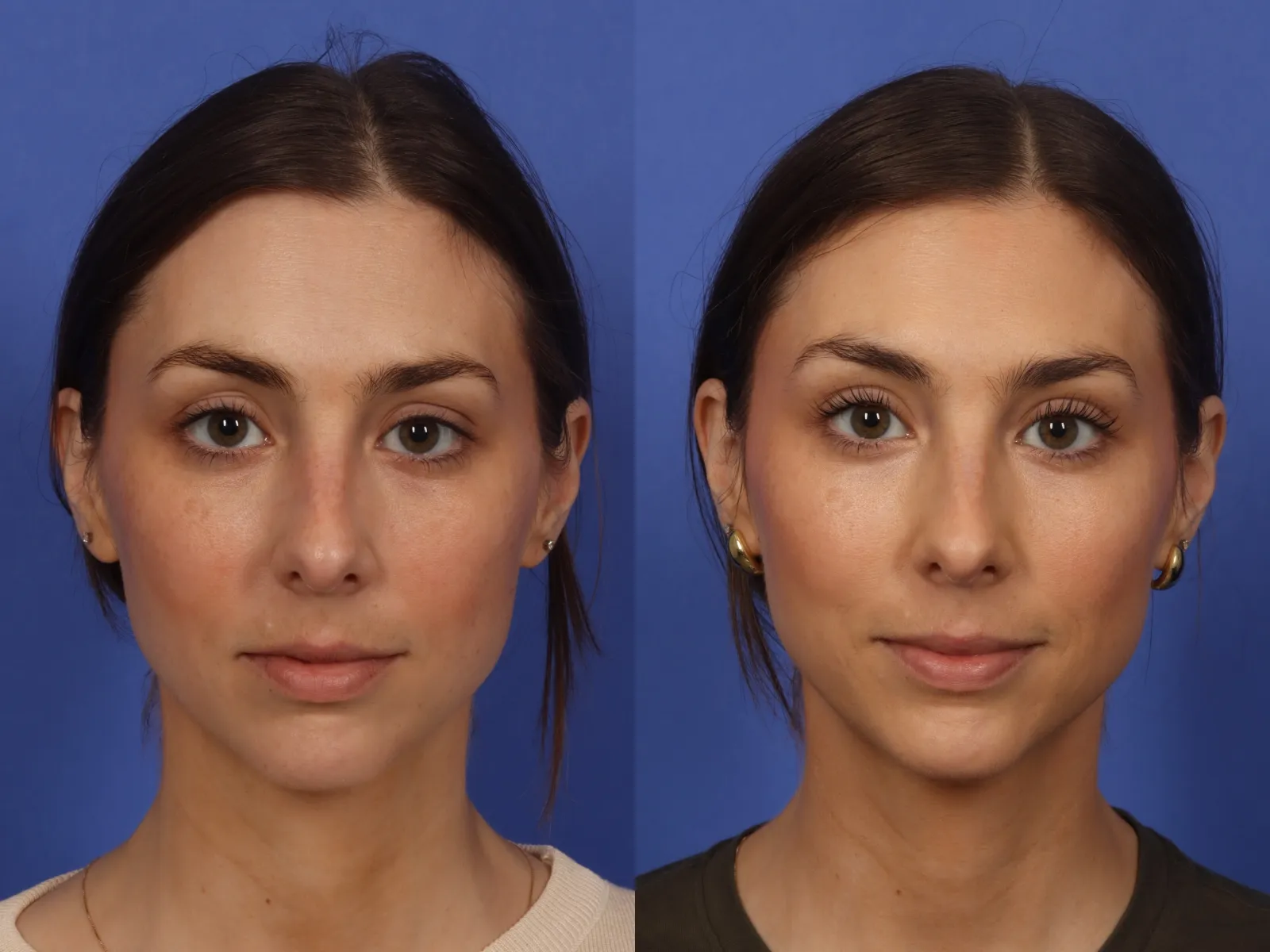 Botox Before and After: What Results Can You Expect? Botox Before and After: What Results Can You Expect?