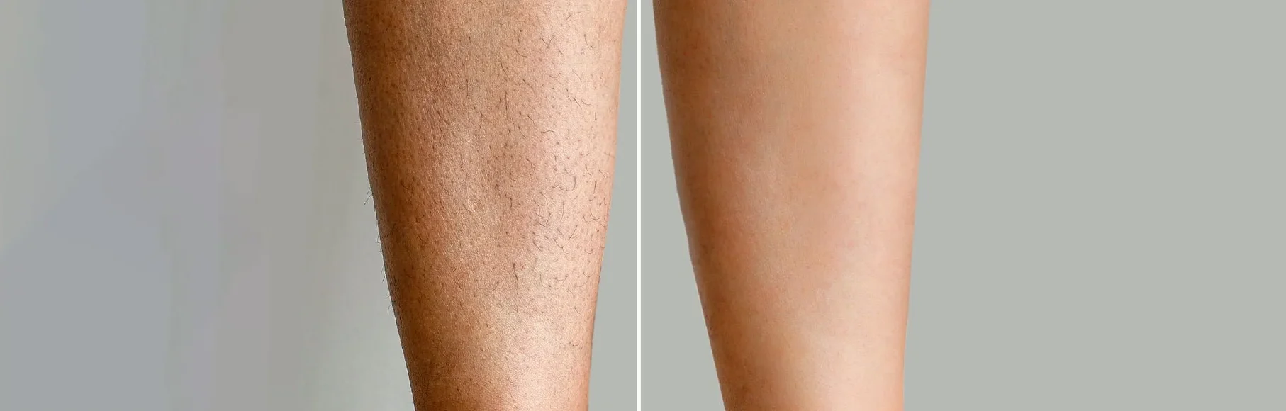 Laser Hair Removal Before and After Results