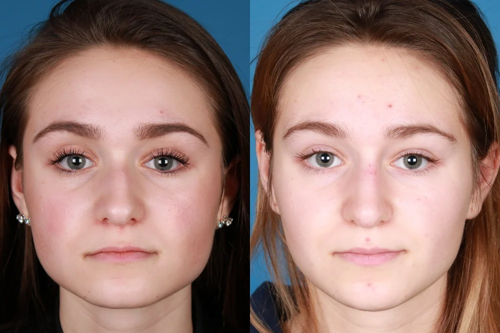 Botox Before and After What Results Really Look Like
