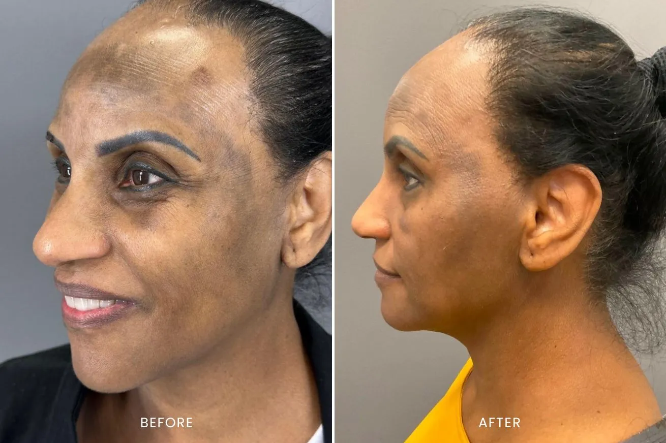 IPL Photo Facial Before and After Results